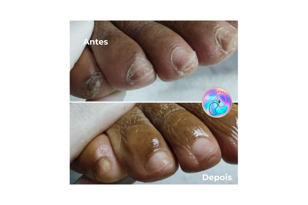 Foto de antes e depois do tratamento 13